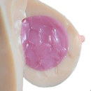 Gel Implant (Jelly breast)
